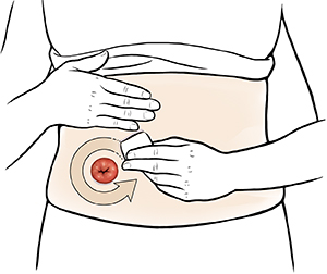 Female abdomen showing hands applying skin barrier around stoma. 