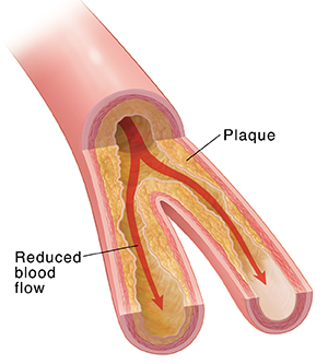 Cross section of artery showing cholesterol buildup and restricted blood flow.