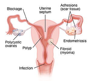 Cross section of female reproductive system showing polycystic ovary, blockage in fallopian tube, fibroid in wall of uterus, endometriosis, adhesions, septum in uterus, polyp in uterus, and Infection in cervix.