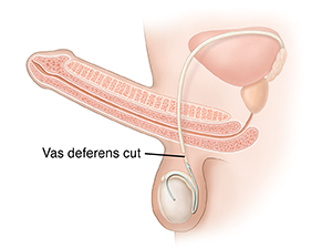 Side view of male reproductive system showing path of sperm after vasectomy.