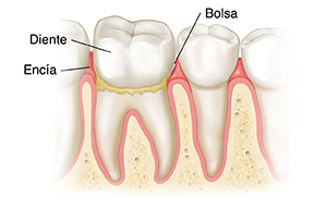 Dientes en encías que muestran gingivitis.