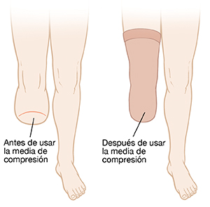 Pierna amputada antes y después de usar un reductor.